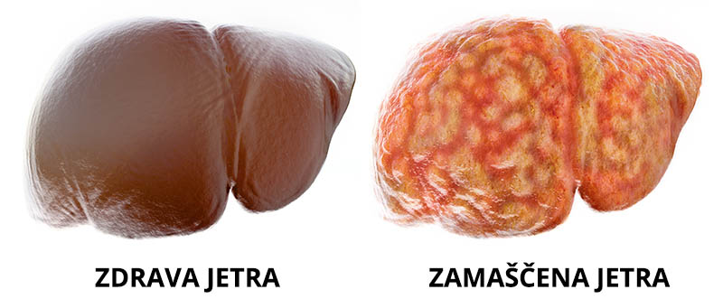 zdrava - zamaščena jetra