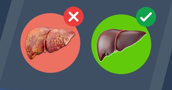 Čiščenje jeter – tako se znebiš maščobe na trebuhu